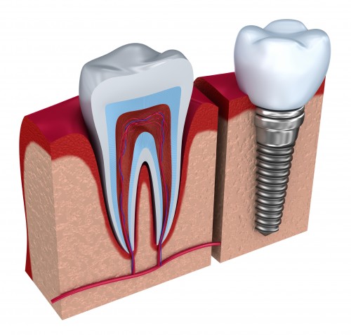 Implantológia